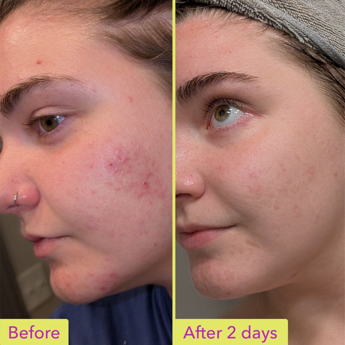 10% Azelaic Acid Treatment