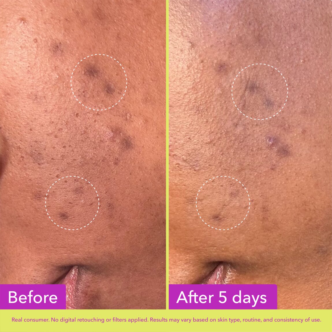 Dark Spot Microdart Patches