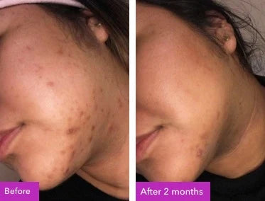 Before and after skin result