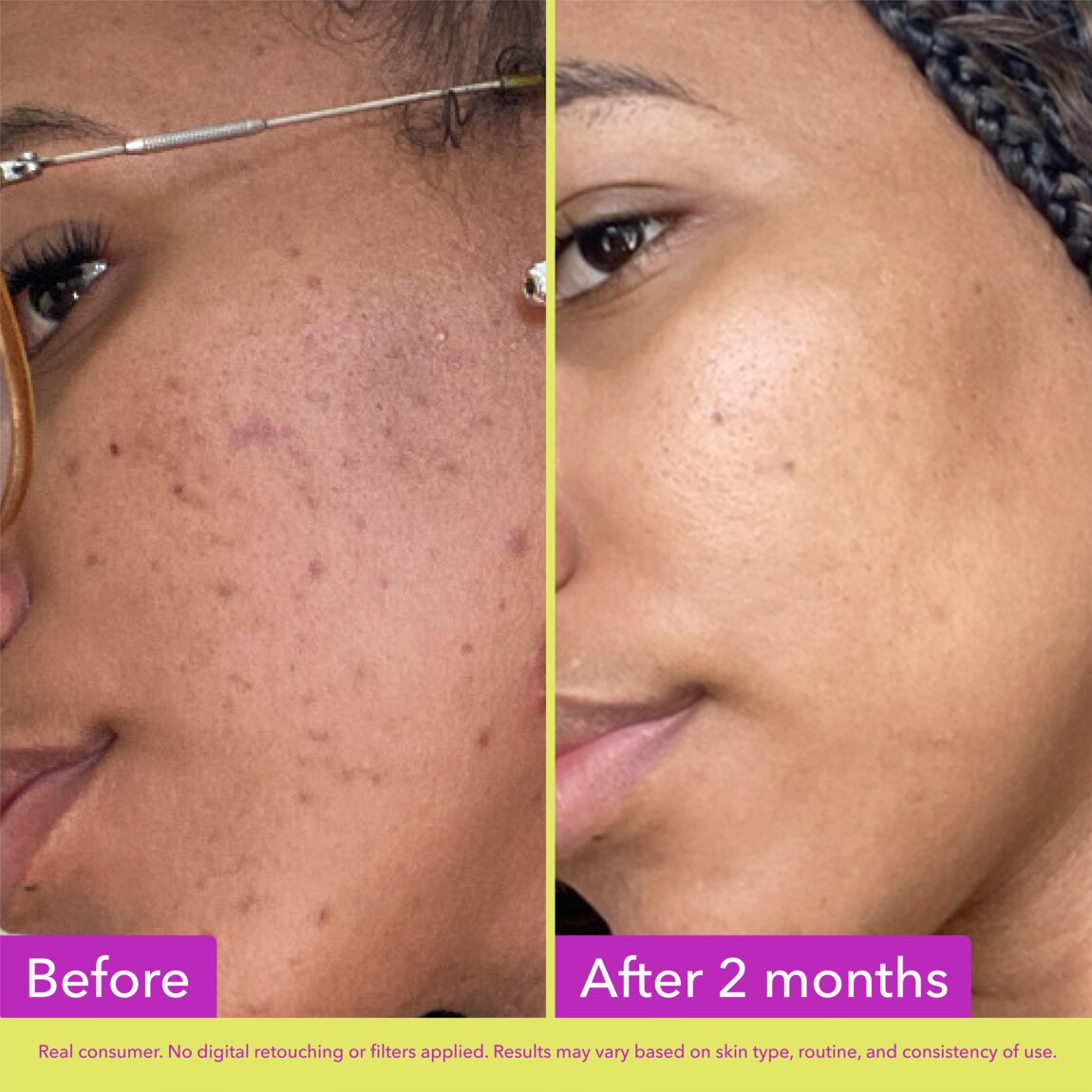 10% Azelaic Acid Treatment