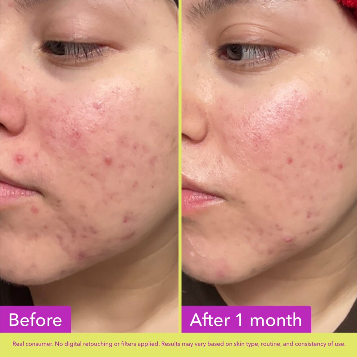 10% Azelaic Acid Treatment