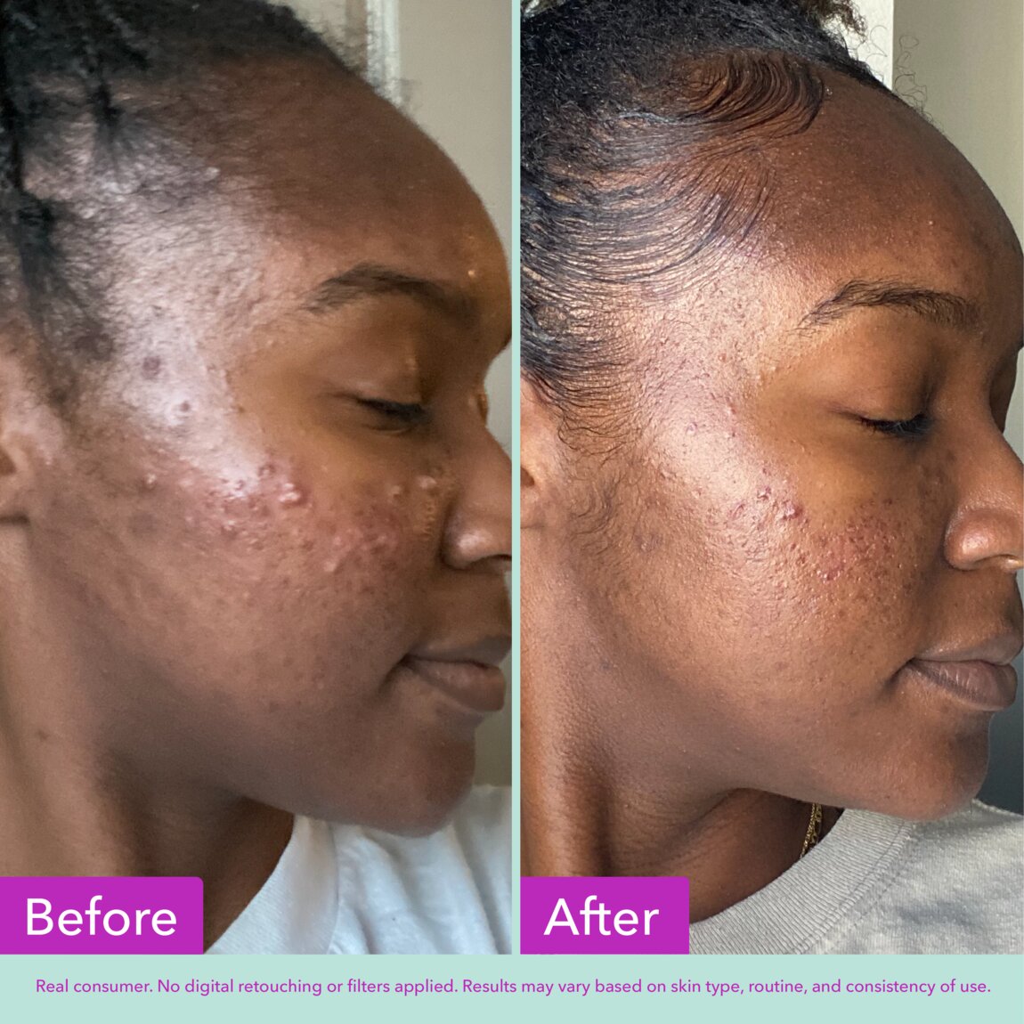 Acne Foaming Cleanser